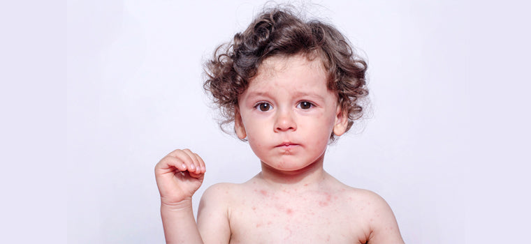 What to do if your child gets measles? | Mother Nurture